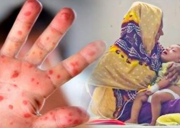 বাংলাদেশে শিশুদের ”হাম” রোগ মহামারি আকারে ছড়াচেছ ৯৪ শিশুর মৃত্যু ১৯ দিনে, টাস্ক ফোর্স গঠনের দাবি ওয়ার্কার্স পার্টির