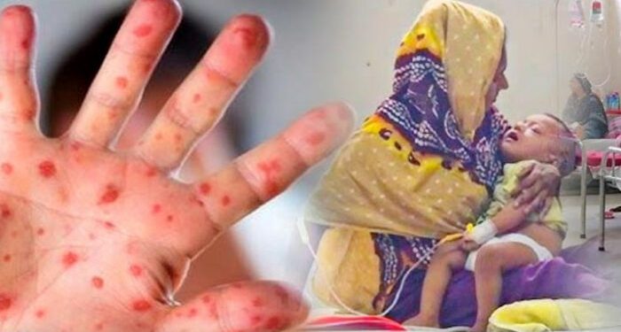 বাংলাদেশে শিশুদের ”হাম” রোগ মহামারি আকারে ছড়াচেছ ৯৪ শিশুর মৃত্যু ১৯ দিনে, টাস্ক ফোর্স গঠনের দাবি ওয়ার্কার্স পার্টির