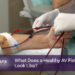 About 17,500 women in Bangladesh are suffering from fistula